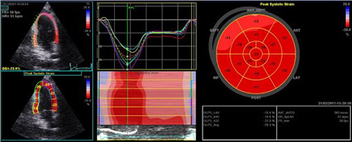 &Mu;&epsilon;&lambda;έ&tau;&eta; &mu;&upsilon;&omicron;&kappa;&alpha;&rho;&delta;&iota;&alpha;&kappa;ή&sigmaf; &pi;&alpha;&rho;&alpha;&mu;ό&rho;&phi;&omega;&sigma;&eta;&sigmaf; (Speckle Tracking Imaging)